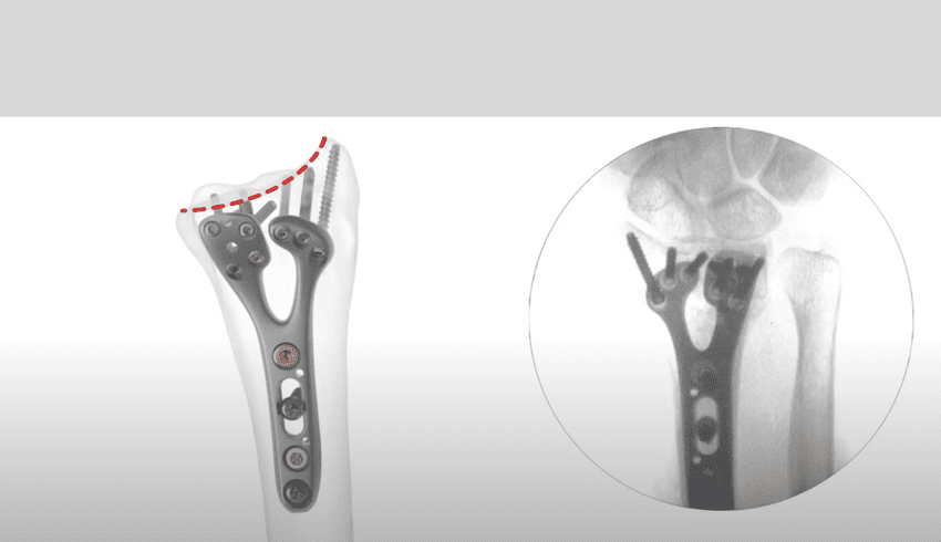 This is what the titanium plate and screws look like in my arm. (not my exact x-ray)