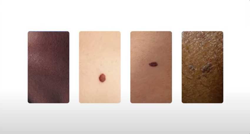 Using AI to help find answers to common skin conditions. Photo, Google.